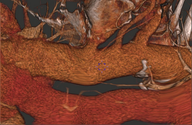 CurvedReformat_After