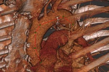 CurvedReformat_Before