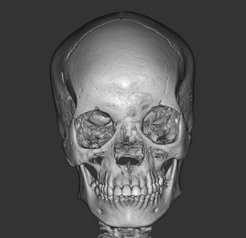 TF_Example1_Skull
